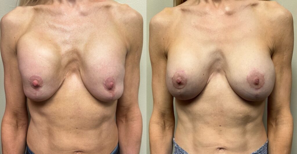 breast implant revision before and after photos by remington plastic surgery in kirkland wa