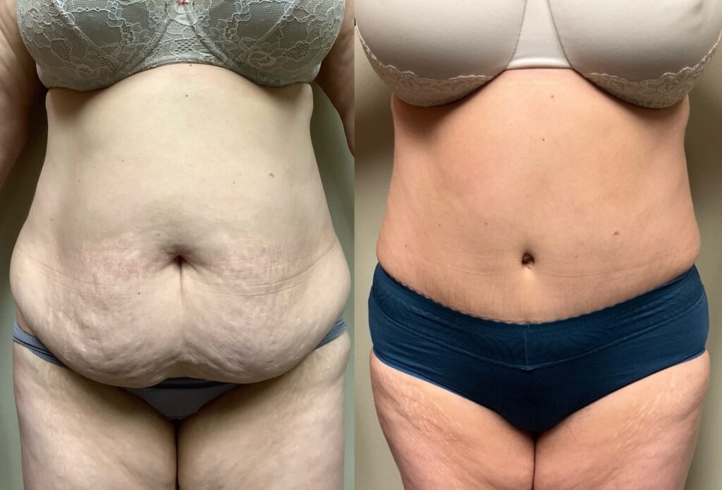 tummy tuck before and after photos by remington plastic surgery in kirkland wa
