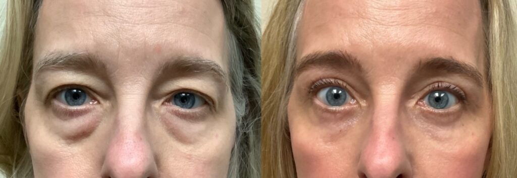 eyelid surgery before and after photos by Remington Plastic Surgery in Kirkland WA
