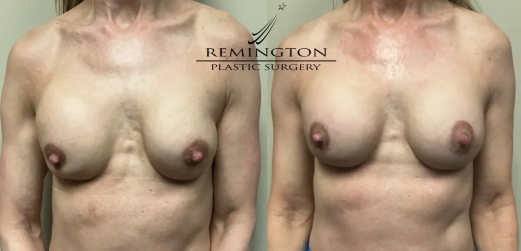 front view breast implant revison before and after photos by Remington Plastic Surgery