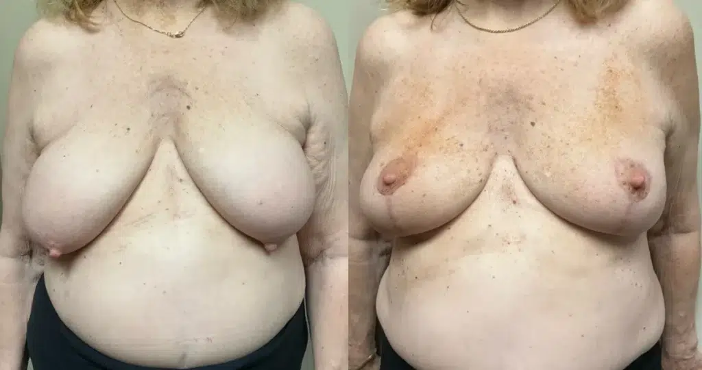 front view breast lift before and after photos by Remington Plastic Surgery