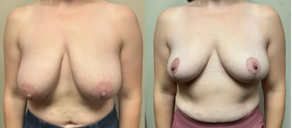 front view breast reduction before and after photos by Remington Plastic Surgery