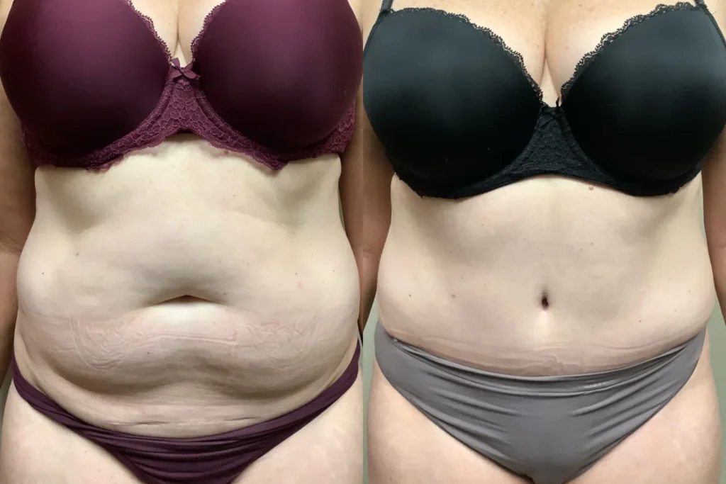 front view tummy tuck before and after photos by Remington Plastic Surgery