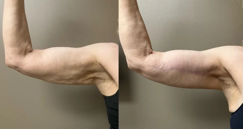 arm lift before and after photos by Remington Plastic Surgery in Kirkland WA