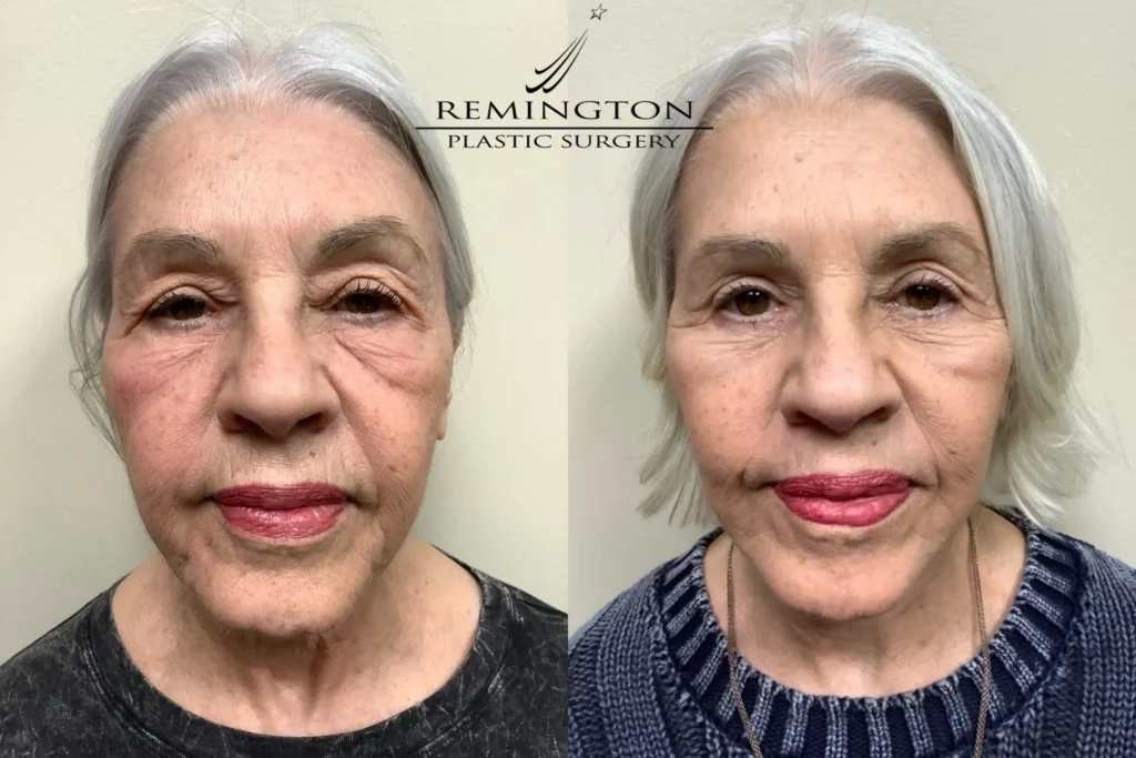 face and neck lift before and after photos by Remington Plastic Surgery in Kirkland WA
