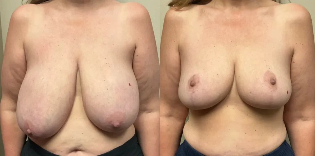 front view breast reduction before and after photos by Remington Plastic Surgery