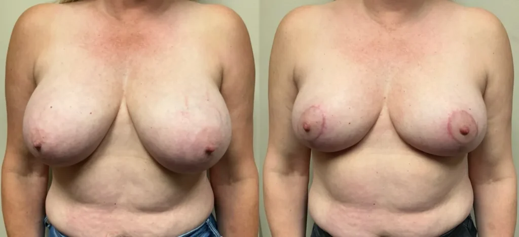 front view breast reduction before and after photos by Remington Plastic Surgery