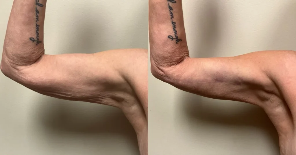 left side view breast reduction before and after photos by Remington Plastic Surgery