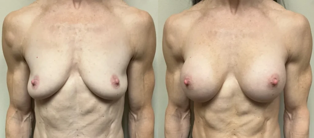 front view breast augmentation before and after photos by Remington Plastic Surgery