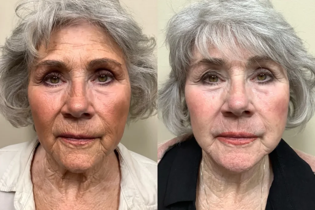 front view facelift before and after photos by Remington Plastic Surgery