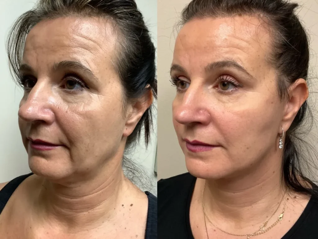 left oblique view facelift before and after photos by Remington Plastic Surgery