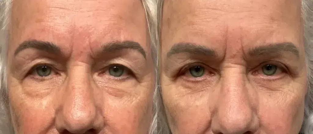 front view eyelid surgery before and after photos by Remington Plastic Surgery ST