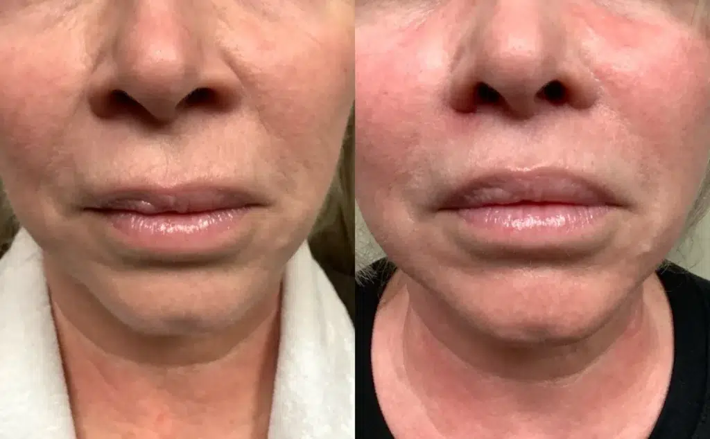 front view lip lift before and after photos by Remington Plastic Surgery ND