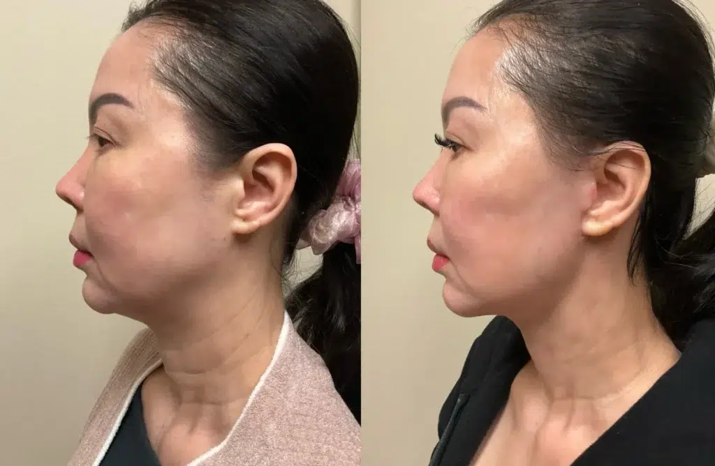 left side view face and neck lift before and after photos by Remington Plastic Surgery KD