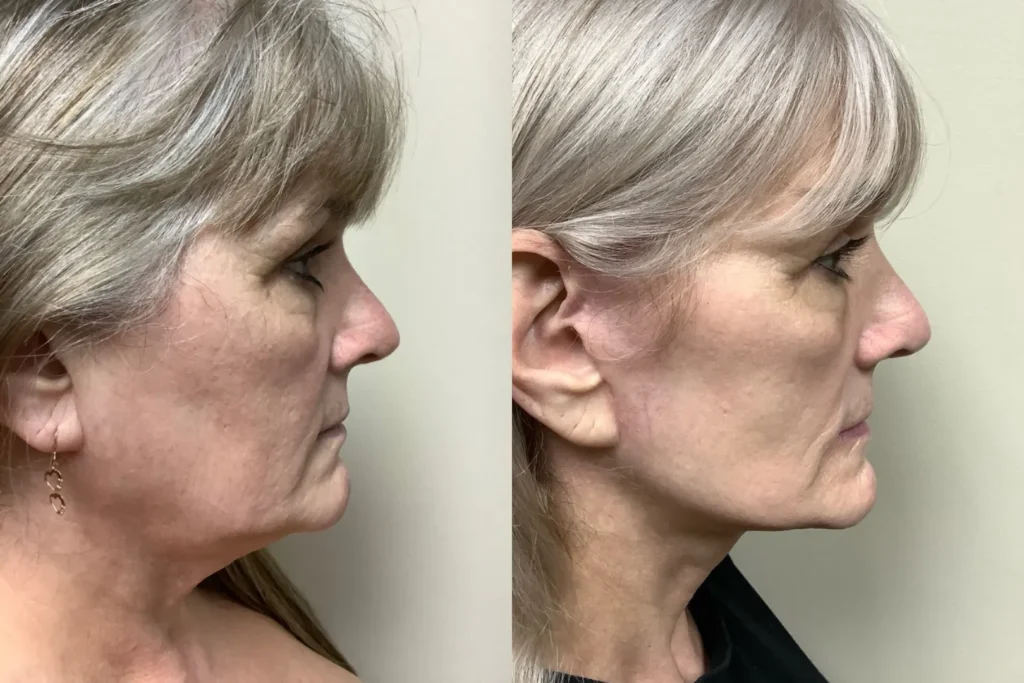 right side view face and neck lift before and after photos by Remington Plastic Surgery MH